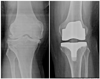 Fast Track Total Knee Replacement A Patient Guide