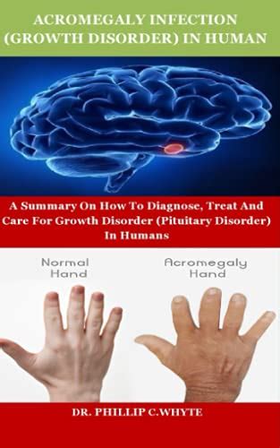 Acromegaly Infection Growth Disorder In Human A Summary On How To