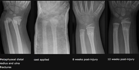 Wrist Distal Radius And Ulna — Dr Carrie Kollias Md Frcsc Fracs