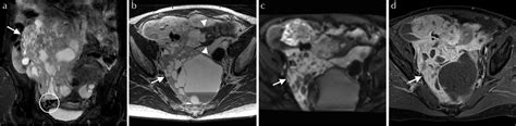 Figure 1 From A Case Of Uterine Tumor Resembling Ovarian Sex Cord Tumor