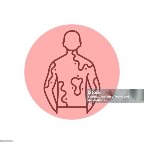 Vitiligo Black Line Icon Autoimmune Diseases Stock Illustration