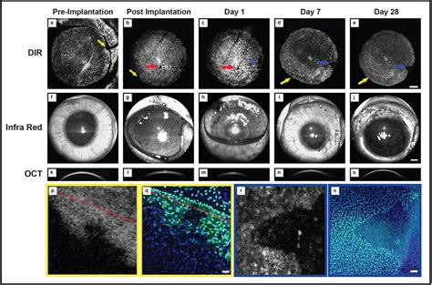 Tracking Of Transplanted Human Corneal Endothelial Cells In Vivo A A