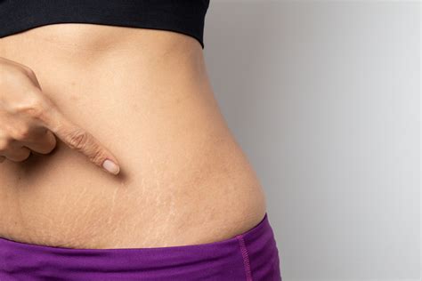 Stretch Marks Causes Treatment And Prevention