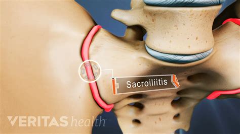 Sacroiliac Joint Dysfunction Symptoms And Causes Spine Health