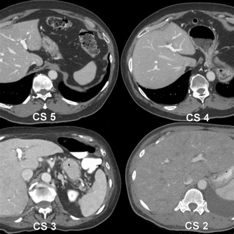 Pdf Delayed Bolus Tracking Trigger At Ct Correlates With Cardiac