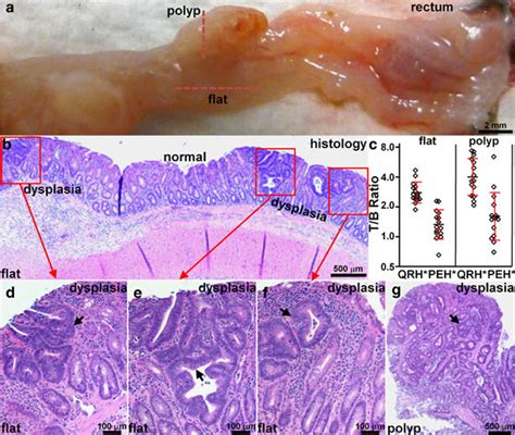 Alidation Of Colonic Dysplasia On Pathology A Excised Colon From