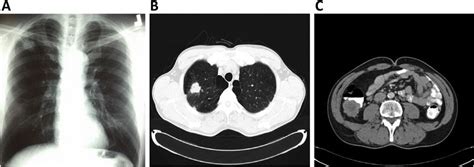 A Chest X Ray Right Upper Lobe Nodule B Chest Computed Tomography