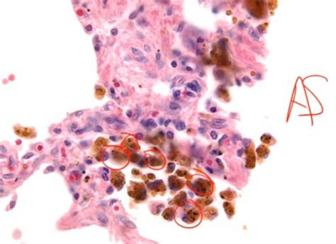 Macrophage With Hemosiderin