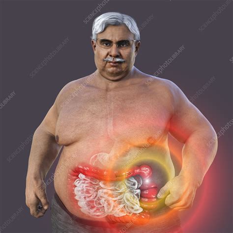 Irritable Bowel Syndrome Illustration Stock Image F