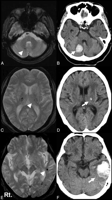 Lacunar Stroke Mri