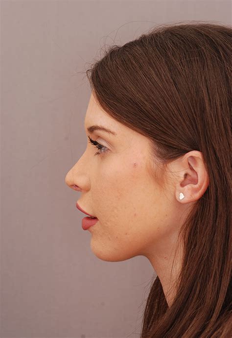 Septorhinoplasty Nose Surgery Rhinoplasty London