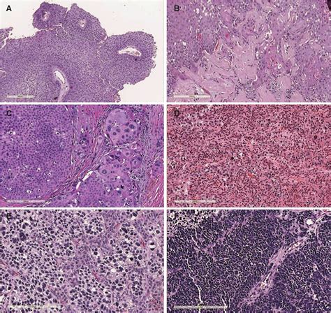 Recurrent Urothelial Carcinoma Like Fgfr Genomic Alterations In