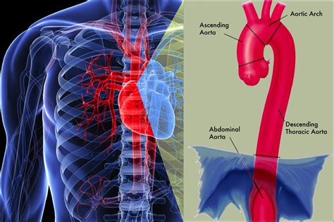 Aorta Artery Aneurysm