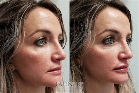 Dermal Fillers Before And After Pictures Case 76 Denver Co Ladner