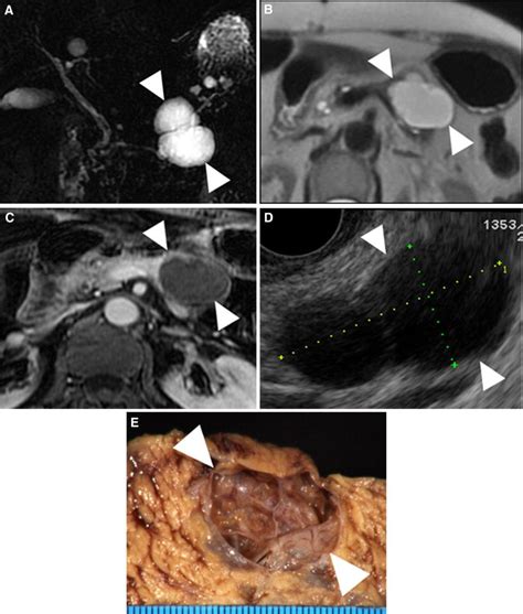 Atypical Serous Cystadenoma D Coronal Thick Slab Mrcp A Axial T Wi