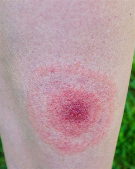 14 Common Bug Bite Pictures How To Id Insect Bites And Stings