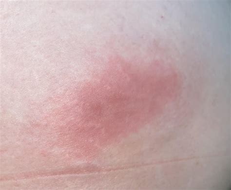 26 Yo Female Taking Nandrolone Deca Rash At Injection Site R Testosterone