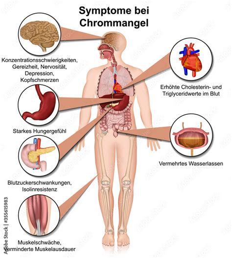 Symptome Bei Chrommangel D Infografik Isoliert Auf Wei En Hintergrund