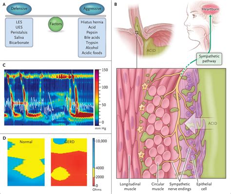 Esophageal Motility Disorders And Gastroesophageal Reflux Disease NEJM