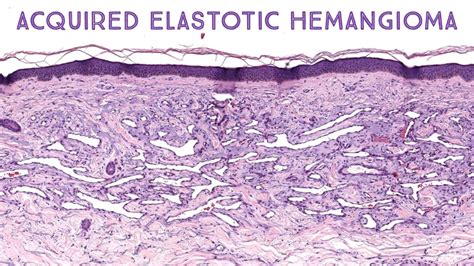 Acquired Elastotic Hemangioma Stony Brook Case 4 Dermatology