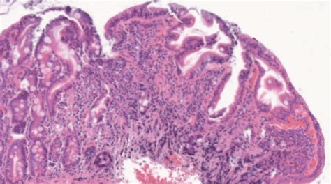 Hematoxilin Eosin Stain Of Duodenal Biopsy Sample Showing Marked