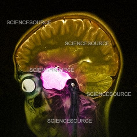 Arachnoid Cyst Mri Scan Stock Image Science Source Images