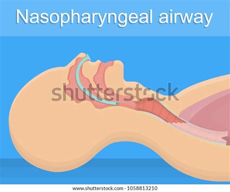 Nasopharyngeal Airway Anatomy