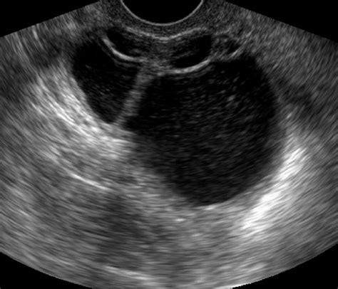 Mucinous Cystadenoma In A 47 Year Old Woman Transvaginal Download