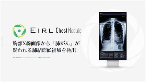 医師の診断支援を行う医用画像解析ソフトウェア「eirl Chest Nodule」新モデルの日本国内での販売が開始 Digital