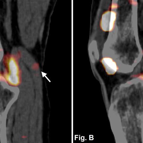 Popliteal Cyst Arrow A 30 Min And B 5 Days After Radiosynovectomy