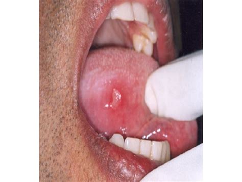 Aphthous Stomatitis Tongue