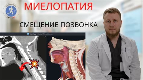 Миелопатия | разбор МРТ - YouTube