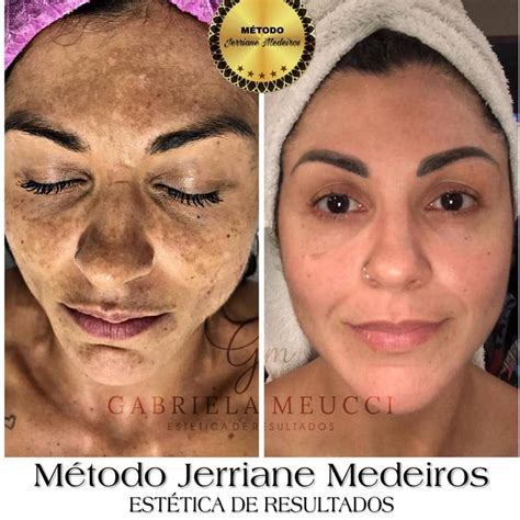 ácido Tranexâmico Injetável Para Melasma Antes E Depois Notícias e