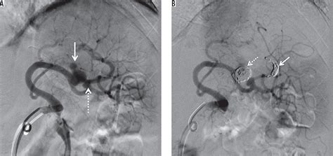 Interventional treatment options in pseudoaneurysms: different ...