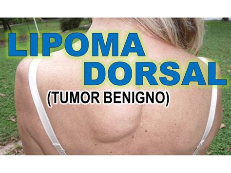 LIPOMA DORSAL TUMOR BENIGNO SUBCUTANEO EN LA ESPALDA YouTube