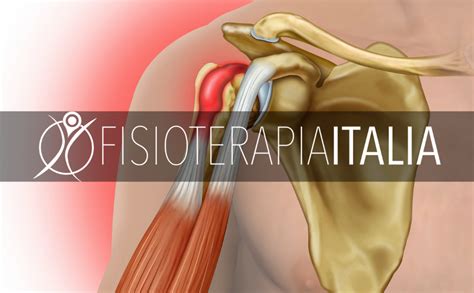 Cuffia Dei Rotatori Patologia E Cura