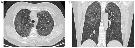 Primary Pulmonary Intravascular Large B‑cell Lymphoma Misdiagnosed As Pneumonia Four Case