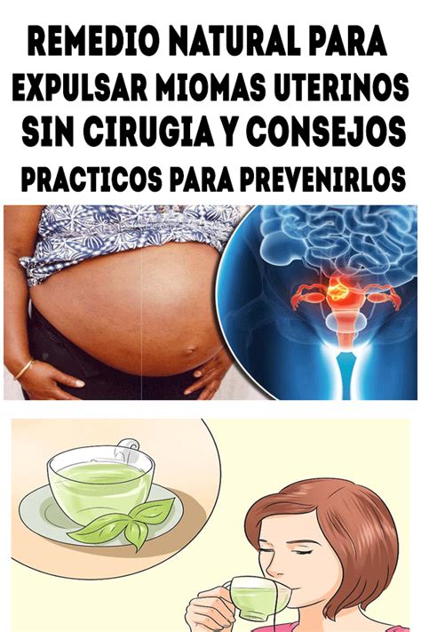 Remedio Natural Para Expulsar Miomas Uterinos Sin Cirugia Y Consejos