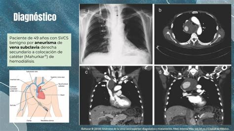 Sindrome Vena Cava Superior Ppt