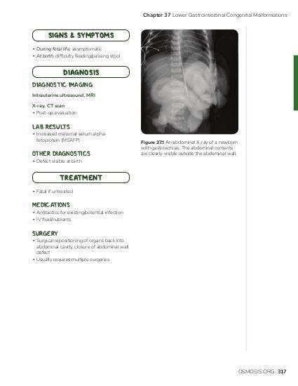 Omphalocele: Video, Causes, & Meaning | Osmosis