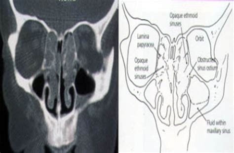 Rhinology Flashcards Quizlet