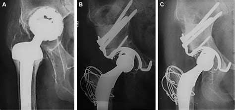 Revision Total Hip Arthroplasty Using The Kerboull Acetabular