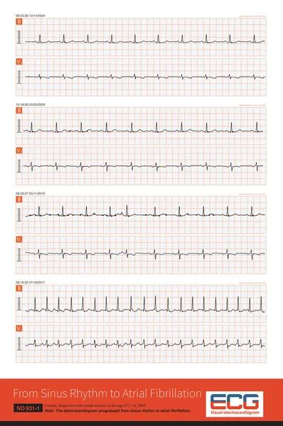 En la práctica clínica la estenosis mitral es una enfermedad común que