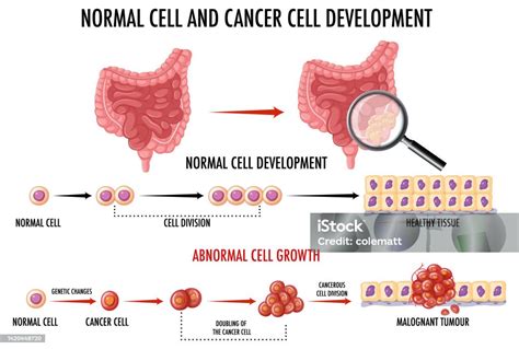 Diagram Showing Normal And Cancer Cells In Human Stock Illustration ...