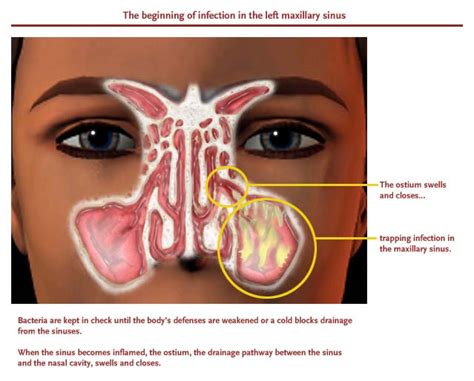 How Bad Can A Sinus Infection Get