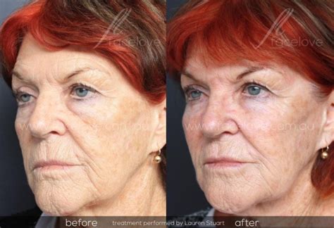 Dermal Filler Treatment For Older Women Facelove