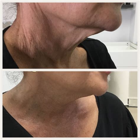 List Pictures Platelet Rich Plasma Before And After Photos Stunning