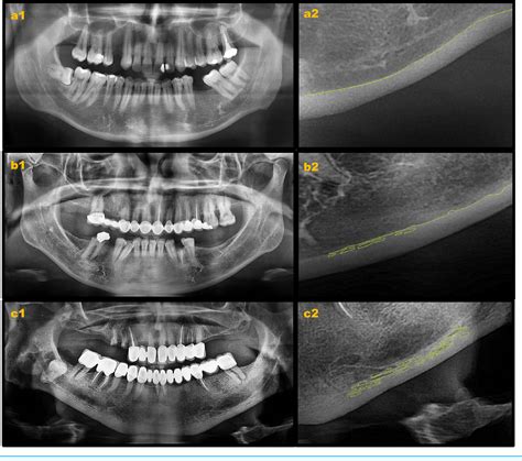 Figure From Evaluation Of Change In Trabecular Bone Structure