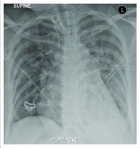 Chest X-ray after aspiration of 1650 mL haemoserous fluid through the ...