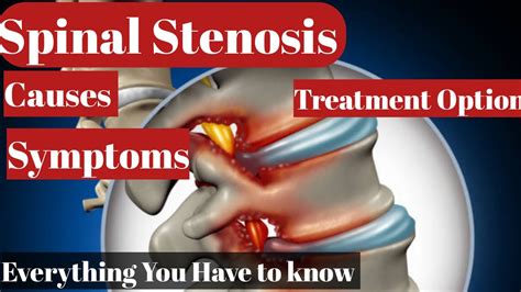 Spinal Stenosis Causes Symptoms How To Diagnose Treatment Options